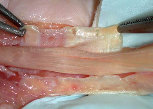 Tendon Sheath Dissection
