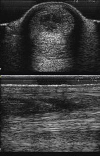 Tendon Lesion