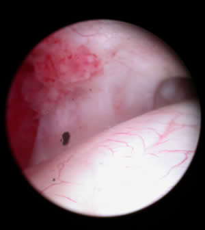 Tenoscopic View