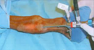 Tenoscopy